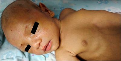 Case Report: A case of Dubin-Johnson syndrome in a newborn